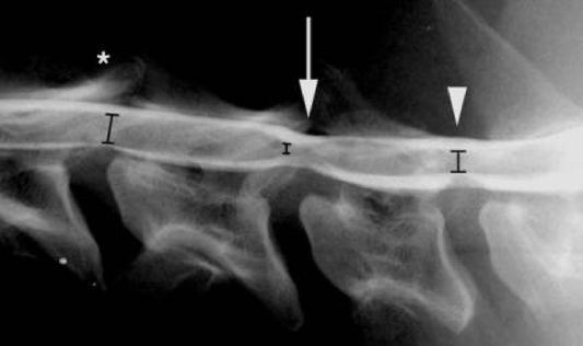 ΣΥΝΔΡΟΜΟ WOBBLER ΑΥΧΕΝΙΚΗ ΣΠΟΝΔΥΛΟΜΥΕΛΟΠΑΘΕΙΑ ΣΚΥΛΟΥ